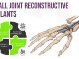 Small Joint Reconstructive Implants